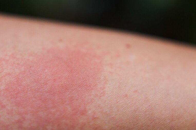 Eine gerötete Stelle auf der Haut Eine gerötete Stelle auf der Haut