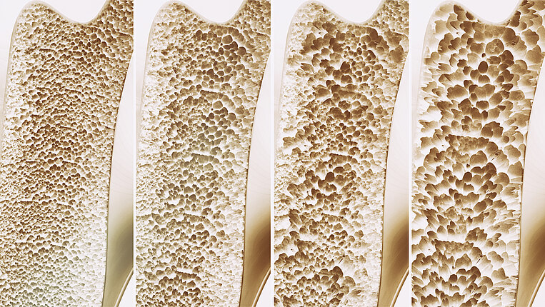 Illustration eines an Osteoporose erkrankten Knochens Illustration eines an Osteoporose erkrankten Knochens