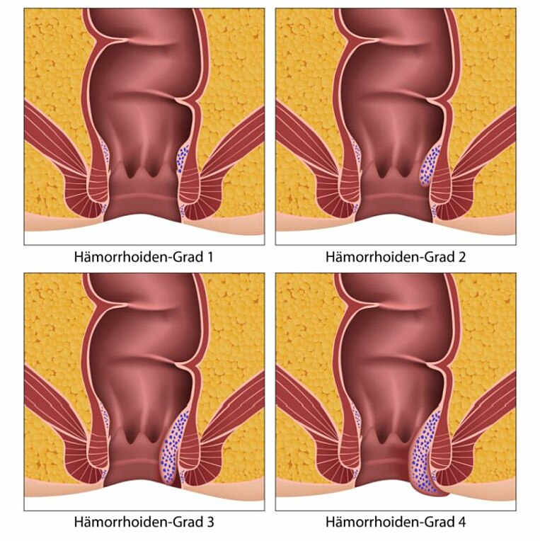 Schweregrade von Hämorrhoidalleiden Schweregrade von Hämorrhoidalleiden