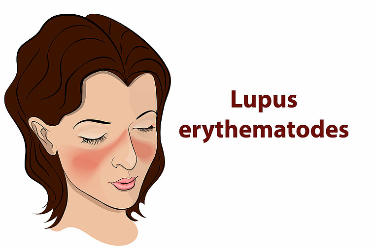 Gesichtsrötungen bei Lupus Gesichtsrötungen bei Lupus
