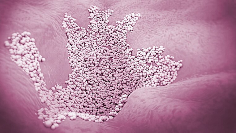 Illustrative Darstellung von Fußpilz auf der Haut Illustrative Darstellung von Fußpilz auf der Haut