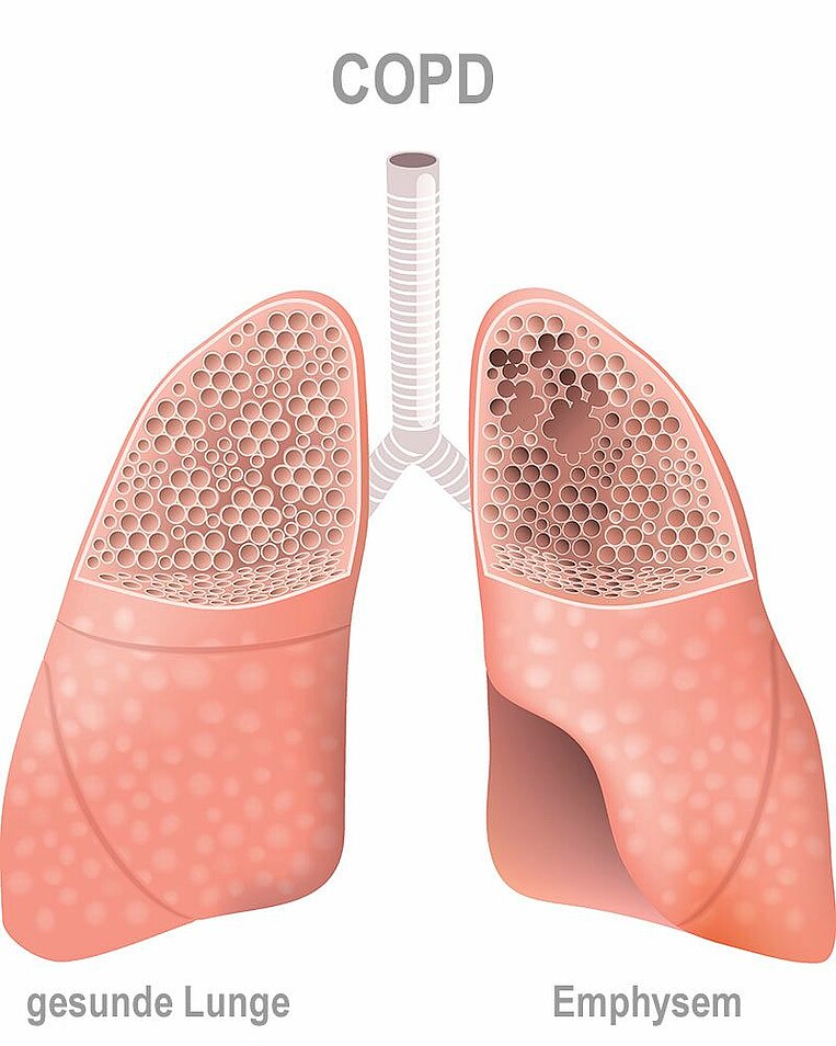 Illustration von gesunder Lunge und Emphysem Illustration von gesunder Lunge und Emphysem