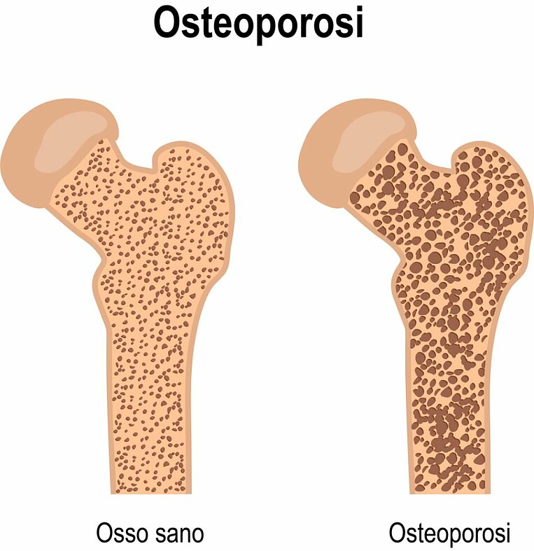 Immagine dell'osteoporosi Illustration von Knochen-Osteoporose
