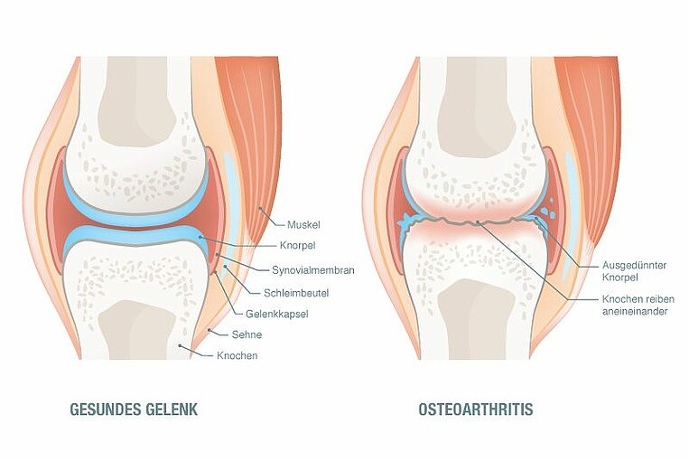Illustration eines gesunden Gelenkes im Vergleich zu Osteoarthritis Illustration eines gesunden Gelenkes im Vergleich zu Osteoarthritis