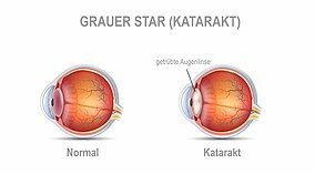 Vergleich von Abbildung eines normalen Auges und eines mit Katarakt