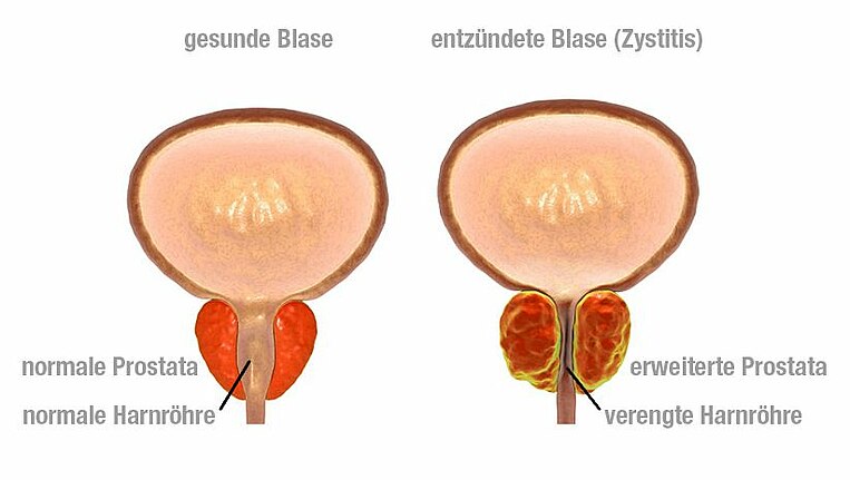 Schaubild zum Vergleich einer gesunden und einer entzündeten Blase Schaubild zum Vergleich einer gesunden und einer entzündeten Blase