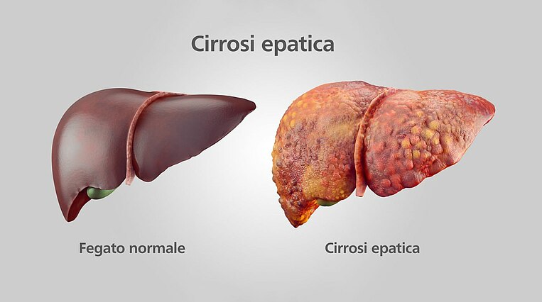 onfronto tra un fegato sano e uno affetto da cirrosi epatica onfronto tra un fegato sano e uno affetto da cirrosi epatica