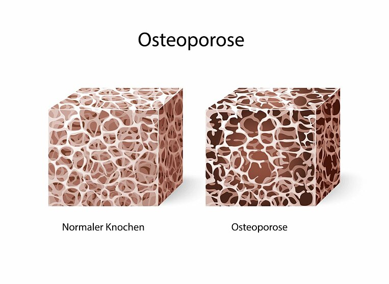 Illustrative Darstellung von Osteoporose Illustrative Darstellung von Osteoporose