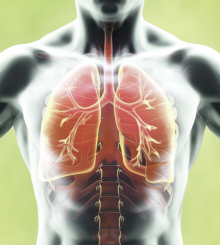 Raffigurazione di un polmone affetto da bronchite Raffigurazione di un polmone affetto da bronchite