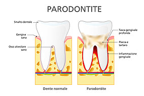 Diagramma per il confronto tra un dente con e uno senza parodontite