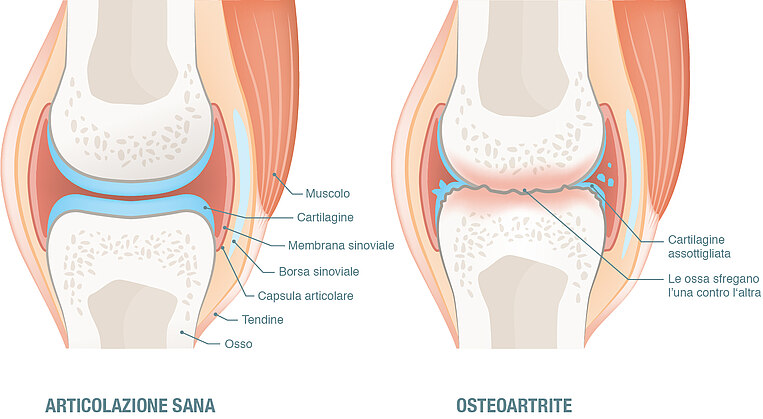 Illustrazione di un'articolazione sana rispetto all'osteoartrite Illustrazione di un'articolazione sana rispetto all'osteoartrite
