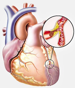 Illustration eines Herzens mit Arteriosklerose