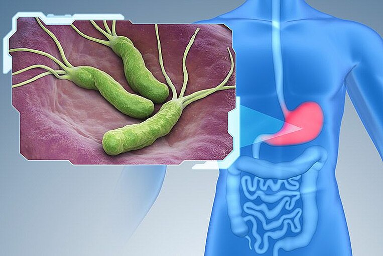 Illustrazione di batteri Helicobacter pylori con indicazione nel tratto gastrointestinale Illustrazione di batteri Helicobacter pylori con indicazione nel tratto gastrointestinale