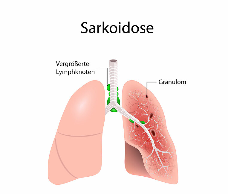 Grafische Darstellung von Granulomen in der Lunge Grafische Darstellung von Granulomen in der Lunge