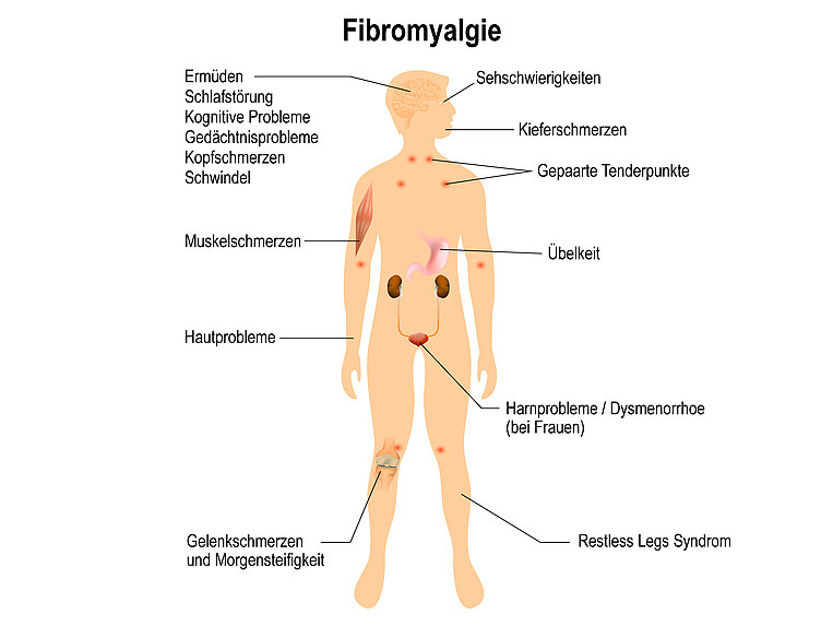 Schaubild eines Menschen mit Einzeichnung von Anzeichen und Symptome von Fibromyalgie Schaubild eines Menschen mit Einzeichnung von Anzeichen und Symptome von Fibromyalgie