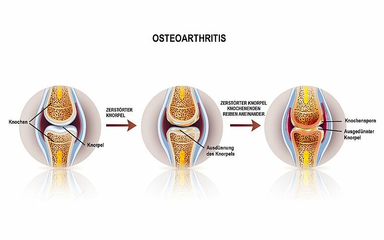 Schaubild von drei Gelenken mit verschiedenen Graden der Osteoarthritis Schaubild von drei Gelenken mit verschiedenen Graden der Osteoarthritis