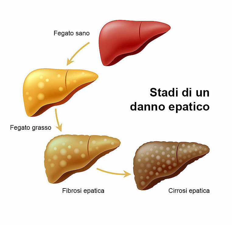 Stadi di un danno epatico Stadi di un danno epatico