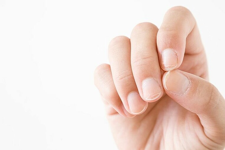 Eine Hand mit beschädigten Nägeln Eine Hand mit beschädigten Nägeln