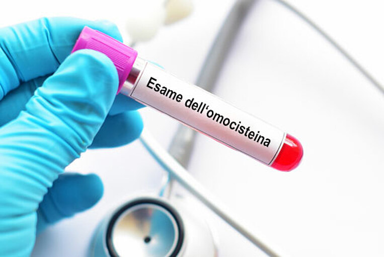 Test di laboratorio sull’omocisteina Test di laboratorio sull’omocisteina