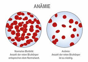 Vergleich der Anzahl der roten Blutkörper bei Anämie und einem gesunden Menschen