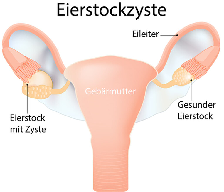 Illustrative Darstellung eines gesunden Eierstocks und eines Eierstocks mit Zyste Illustrative Darstellung eines gesunden Eierstocks und eines Eierstocks mit Zyste