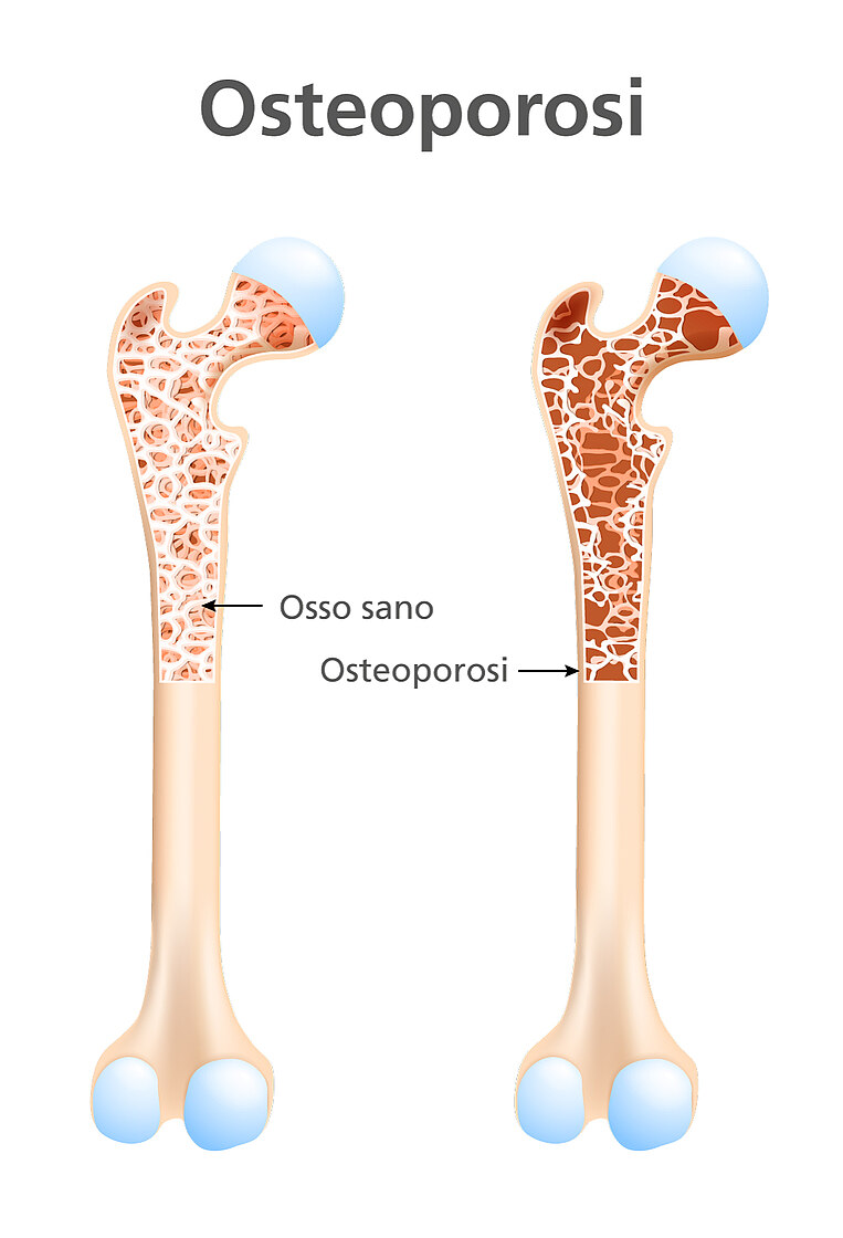 Confronto tra un osso sano e uno colpito da osteoporosi Confronto tra un osso sano e uno colpito da osteoporosi