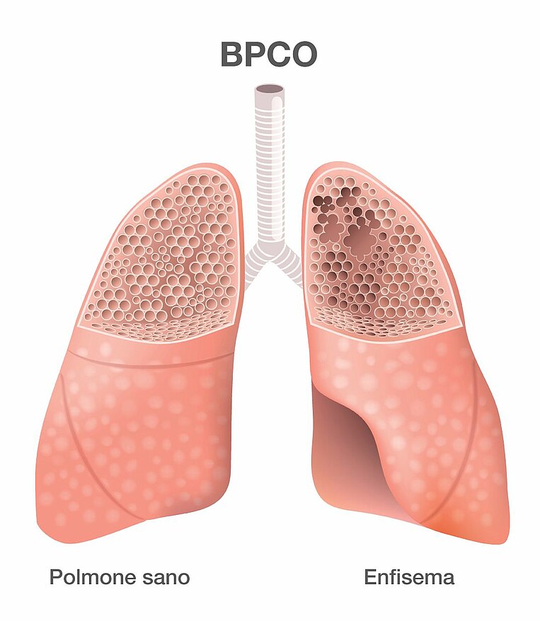 Immagine di un polmone sano e di uno con enfisema Immagine di un polmone sano e di uno con enfisema