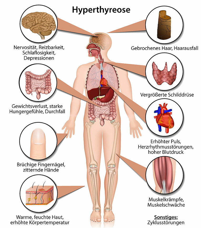 Grafische Darstellung der Symptome von Hyperthyreose Grafische Darstellung der Symptome von Hyperthyreose