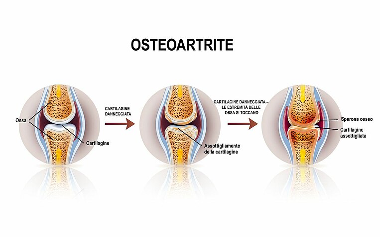 Illustrazione di tre articolazioni con diversi gradi di osteoartrite Illustrazione di tre articolazioni con diversi gradi di osteoartrite