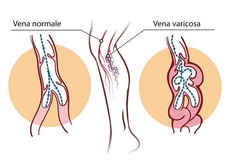 Illustrazione di vene normali e vene varicose Illustrazione di vene normali e vene varicose