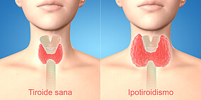 Due immagini che mostrano una ghiandola tiroidea sana e una ghiandola tiroidea ipofunzionante