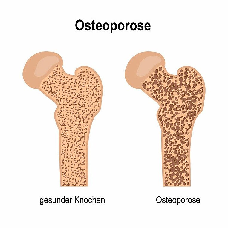 Illustration von Knochen-Osteoporose Illustration von Knochen-Osteoporose