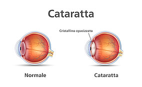 Immagine di un occhio normale e un occhio con cataratta a confronto