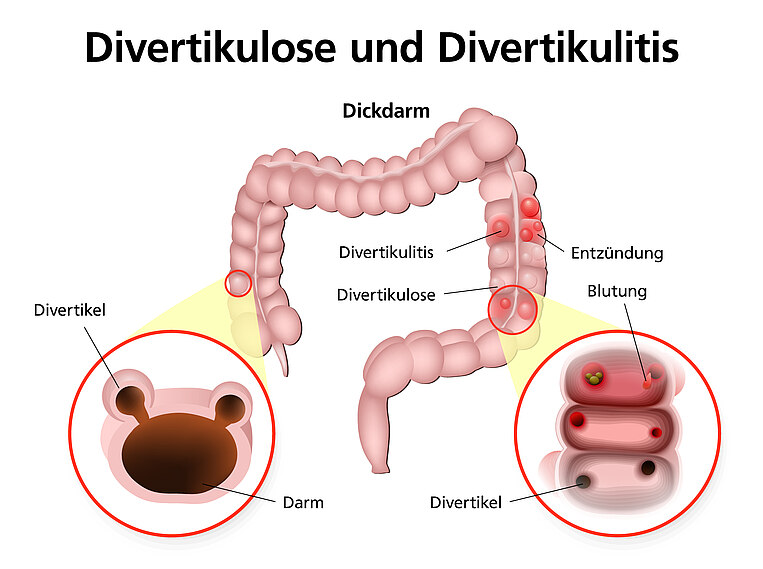 Graphische Darstellung einer Divertikulose und Divertikulitis Graphische Darstellung einer Divertikulose und Divertikulitis