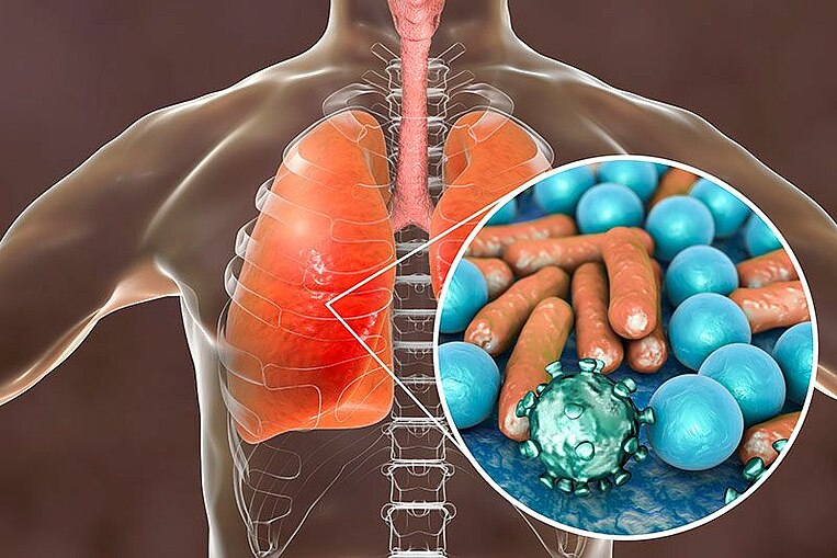 Illustration eines Lungeninfekts Illustration eines Lungeninfekts