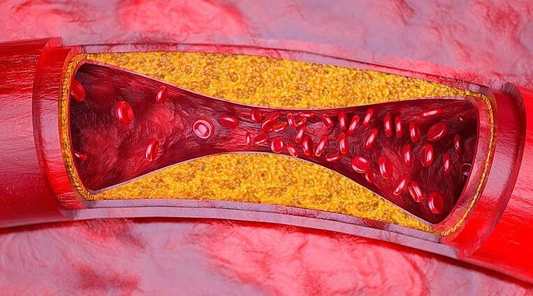 Illustration einer Arteriosklerose Illustration einer Arteriosklerose