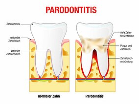 Schaubild zum Vergleich eines Zahnes mit und ohne Parodontitis