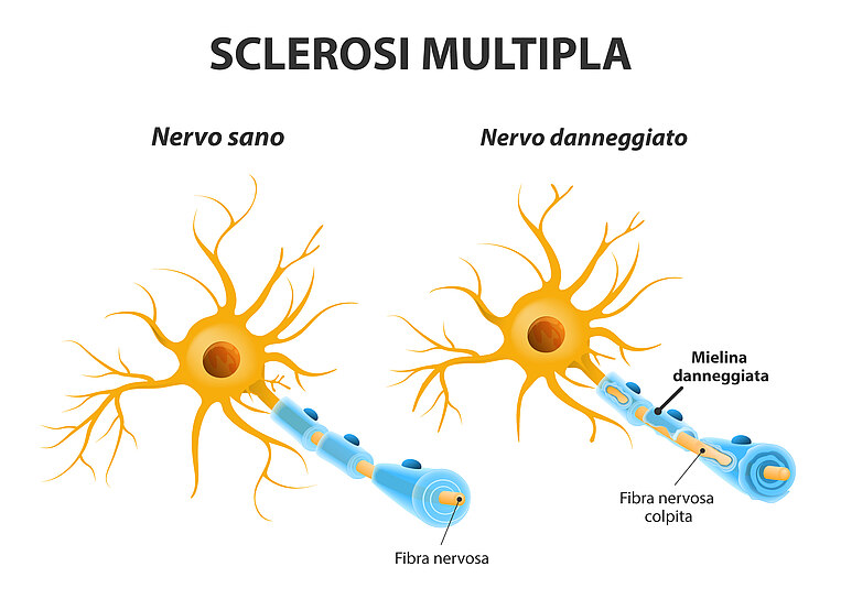 Immagine di un nervo sano e di uno danneggiato Immagine di un nervo sano e di uno danneggiato