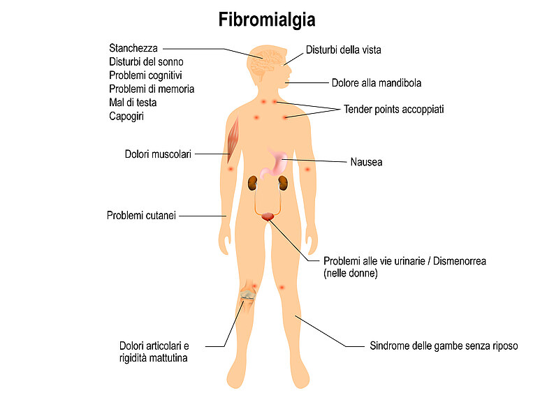 Immagine di un uomo con l’indicazione dei segni e dei sintomi di una fibromialgia Immagine di un uomo con l’indicazione dei segni e dei sintomi di una fibromialgia