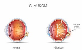 Glaukom: wichtige Augennährstoffe
