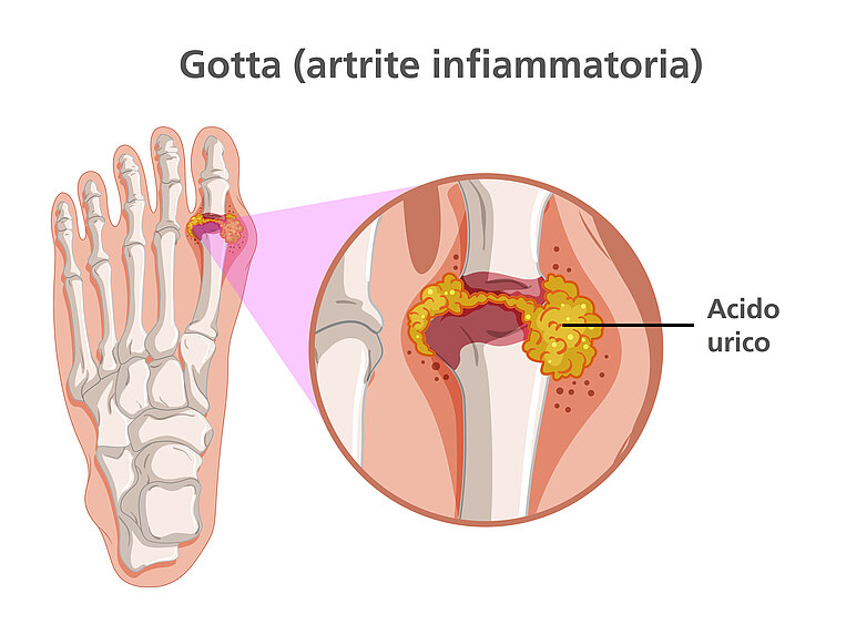 Immagine: Cosa accade in caso di gotta Immagine: Cosa accade in caso di gotta