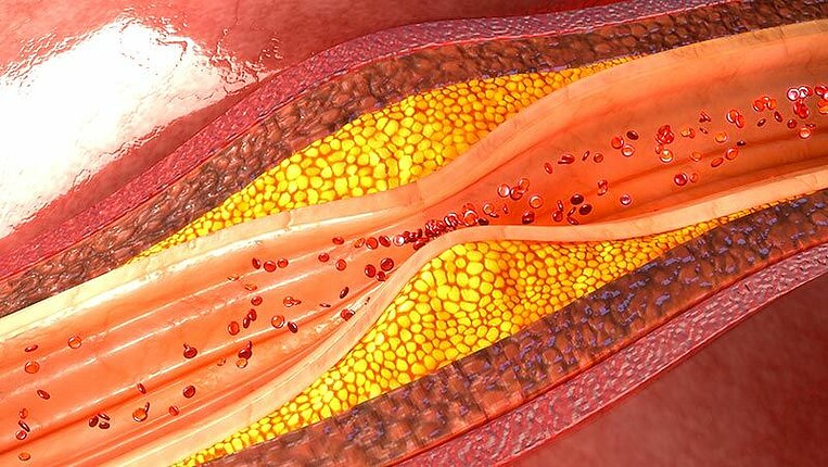 Sezione di un’arteria coronaria Sezione di un’arteria coronaria