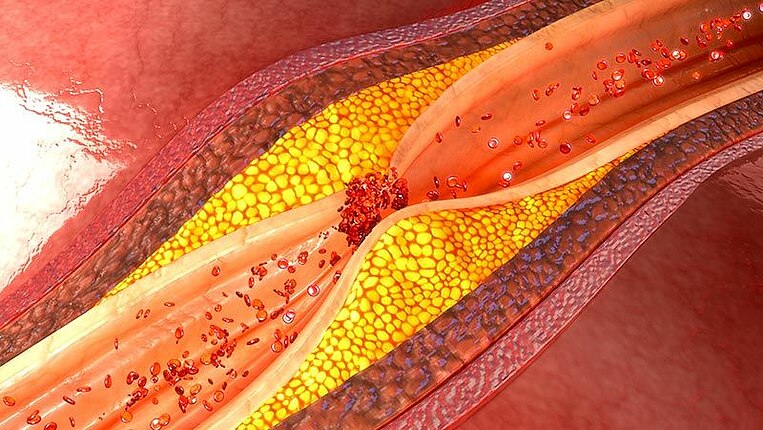 Querschnitt einer Arterie Querschnitt einer Arterie