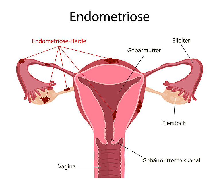 Illustrative Darstellung von Endometriose Illustrative Darstellung von Endometriose