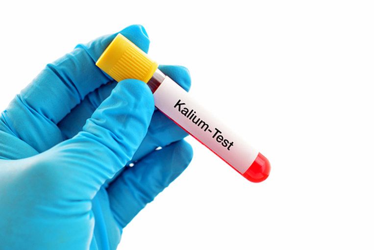 Ein Kalium-Bluttest Ein Kalium-Bluttest
