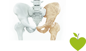Vergleich eines gesunden und eines Osteoporose leidenen Beckens Vergleich eines gesunden und eines Osteoporose leidenen Beckens